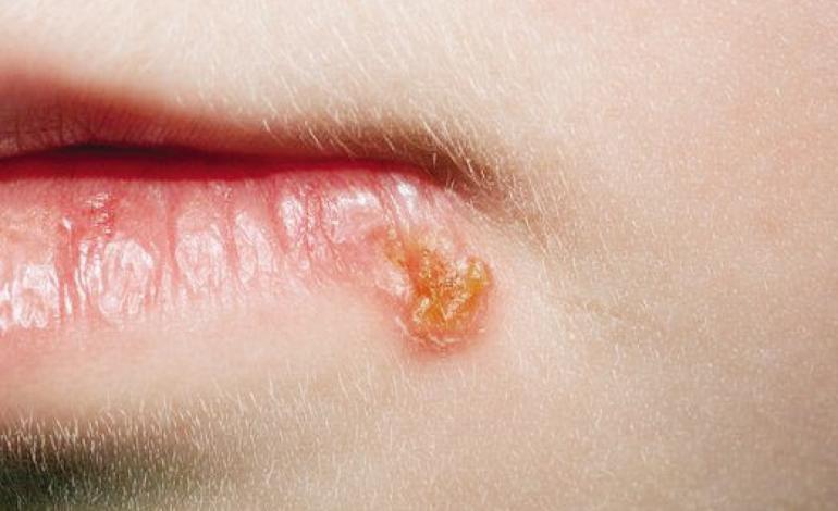 تبخال را با یخ درمان کنید