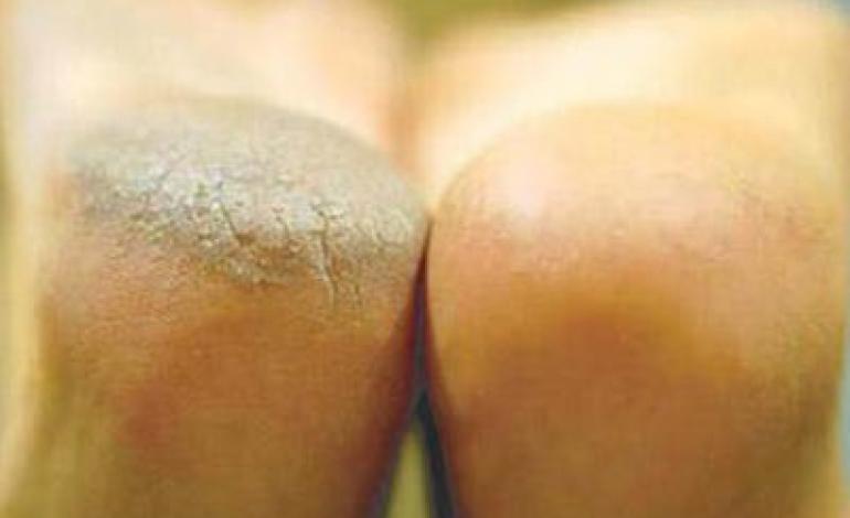 درمان ترک پا با عسل