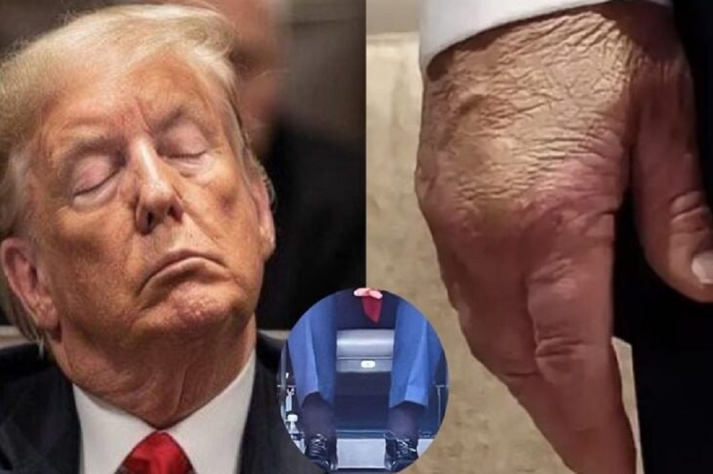 کبودی روی دستهای ترامپ نشانه چیست؟