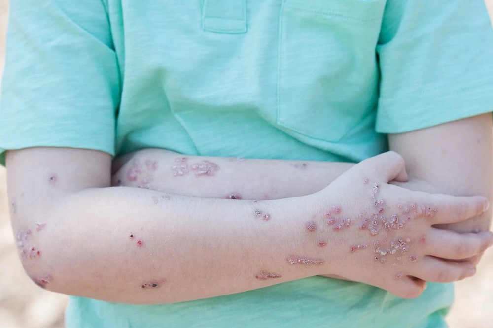 تحریم‌های آمریکا به قیمت جان بیماران پروانه‌ای ایران